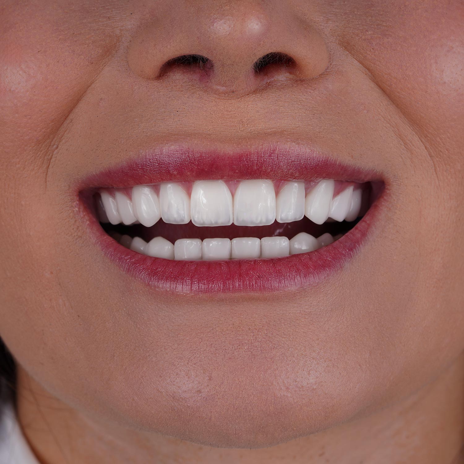 istadental-emax-beforeafter-107