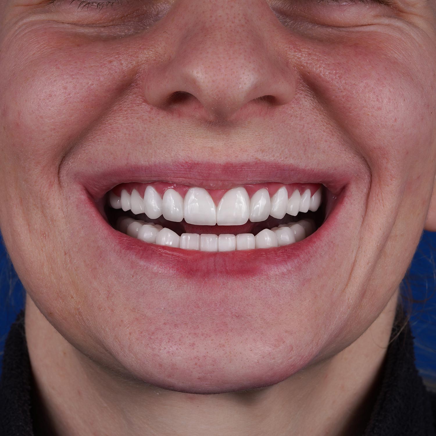 istadental-emax-beforeafter-108