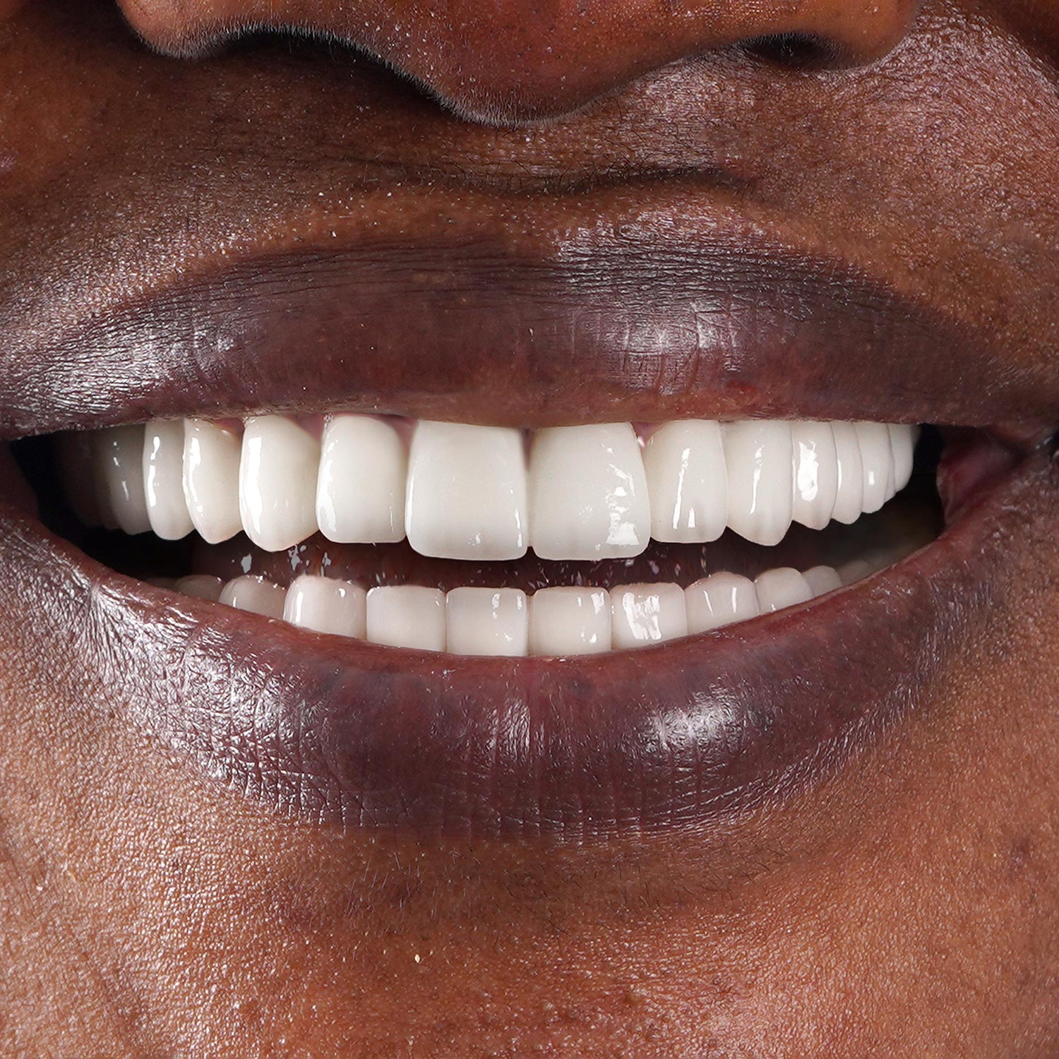 istadental-implant-beforeafter-100