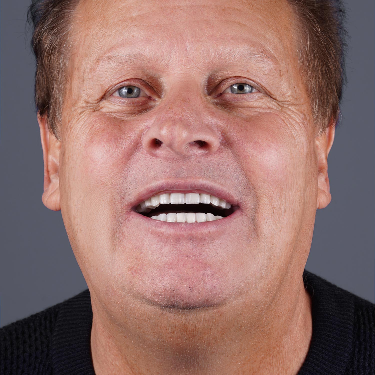 istadental-implant-beforeafter-102