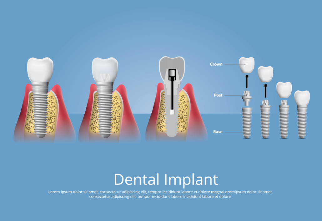 implantat-implantat-in-turkei