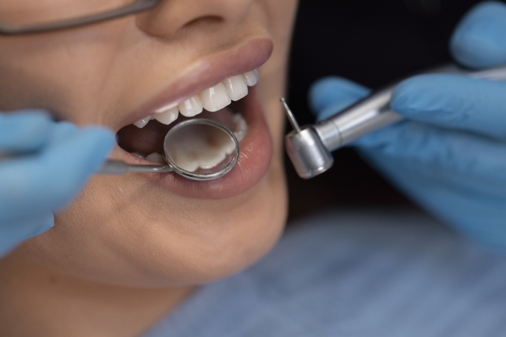 Zahnsteinentfernung während einer professionellen dentalen Reinigung mit modernen Geräten
