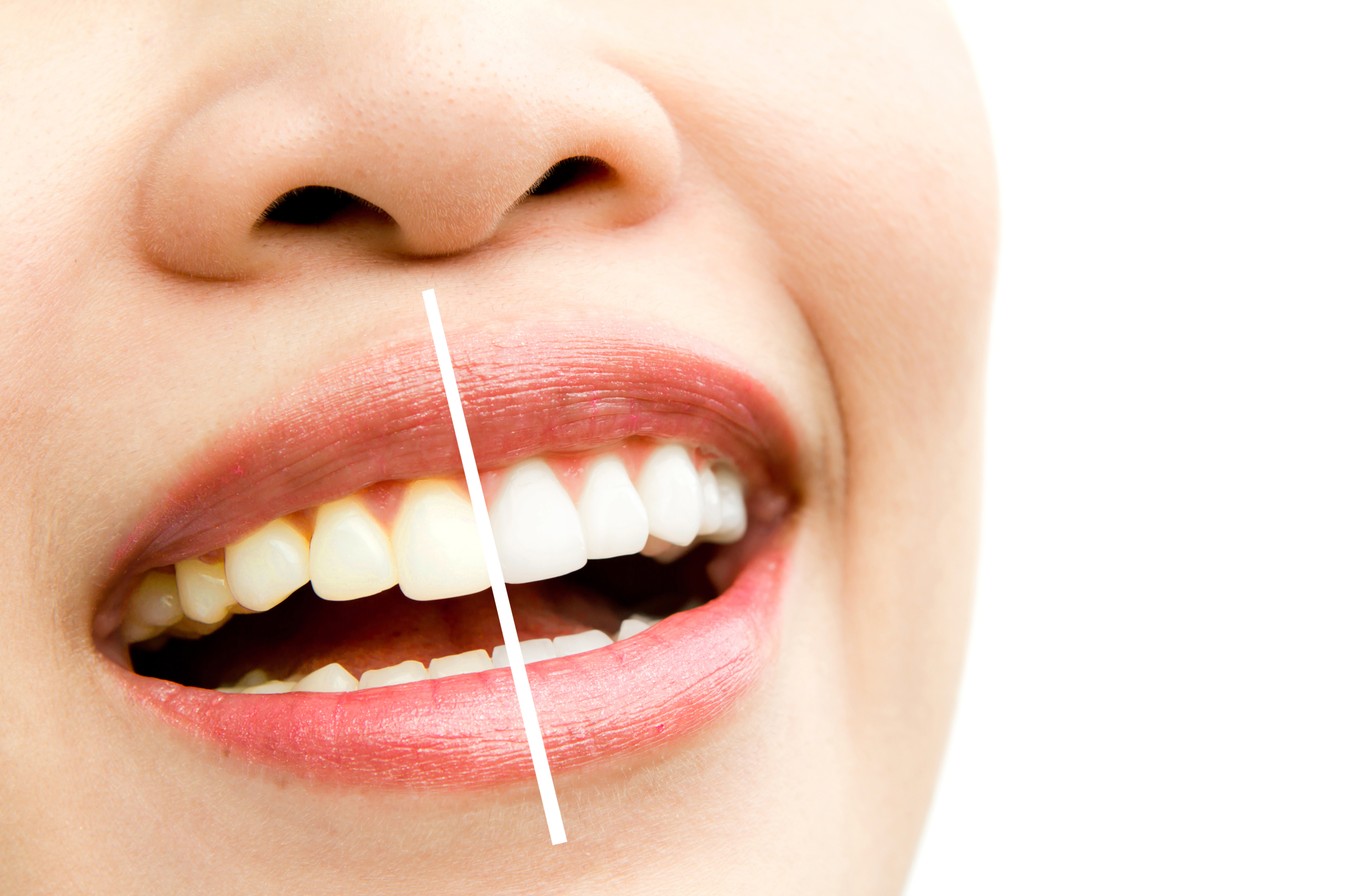 Is Teeth Whitening Harmful ?