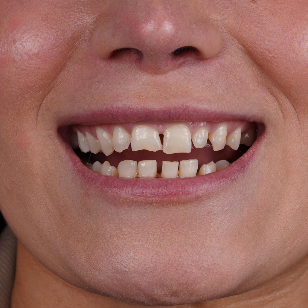 istadental-emax-img3 istadental-emax-img3