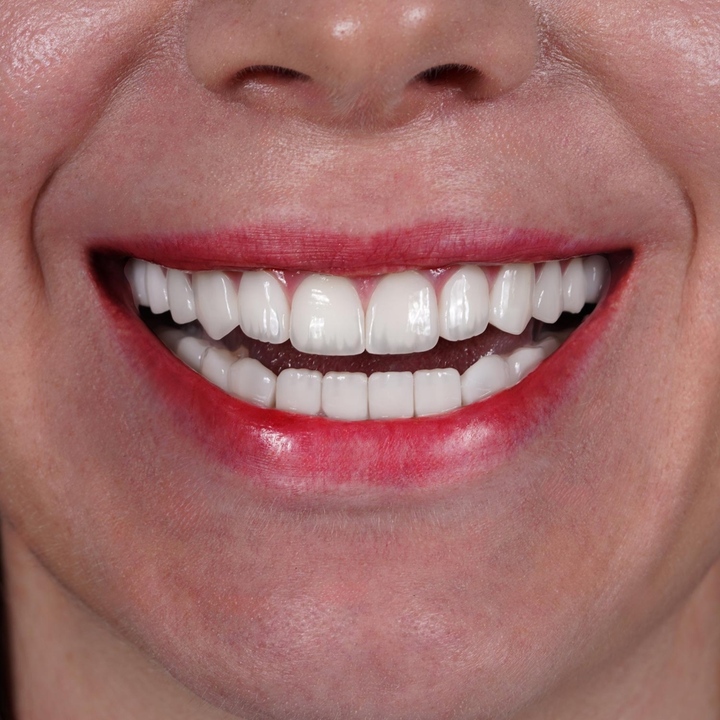 istadental-emax-img6