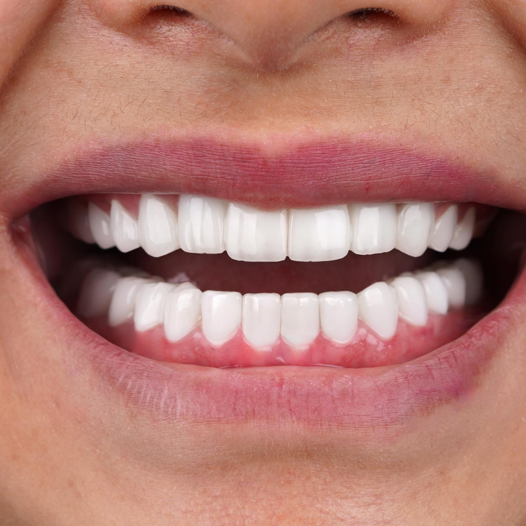 istadental-emax-img8